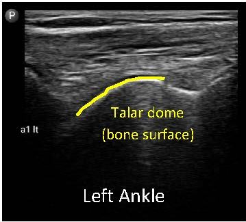 Left ankle with talar dome highlighted