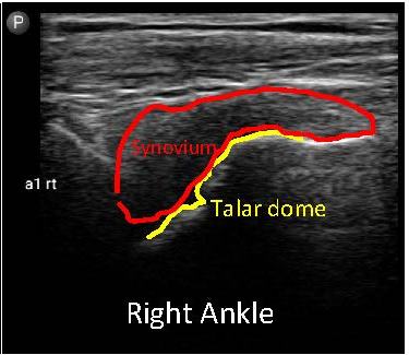 right ankle with synovium and talar dome highlighted